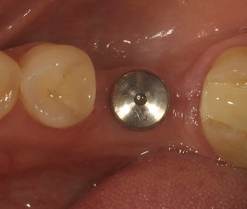 Dental Implant Placement Winchester VA, Dental Implant Placement Process