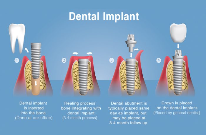 Un diagrama del proceso de colocación de implantes 